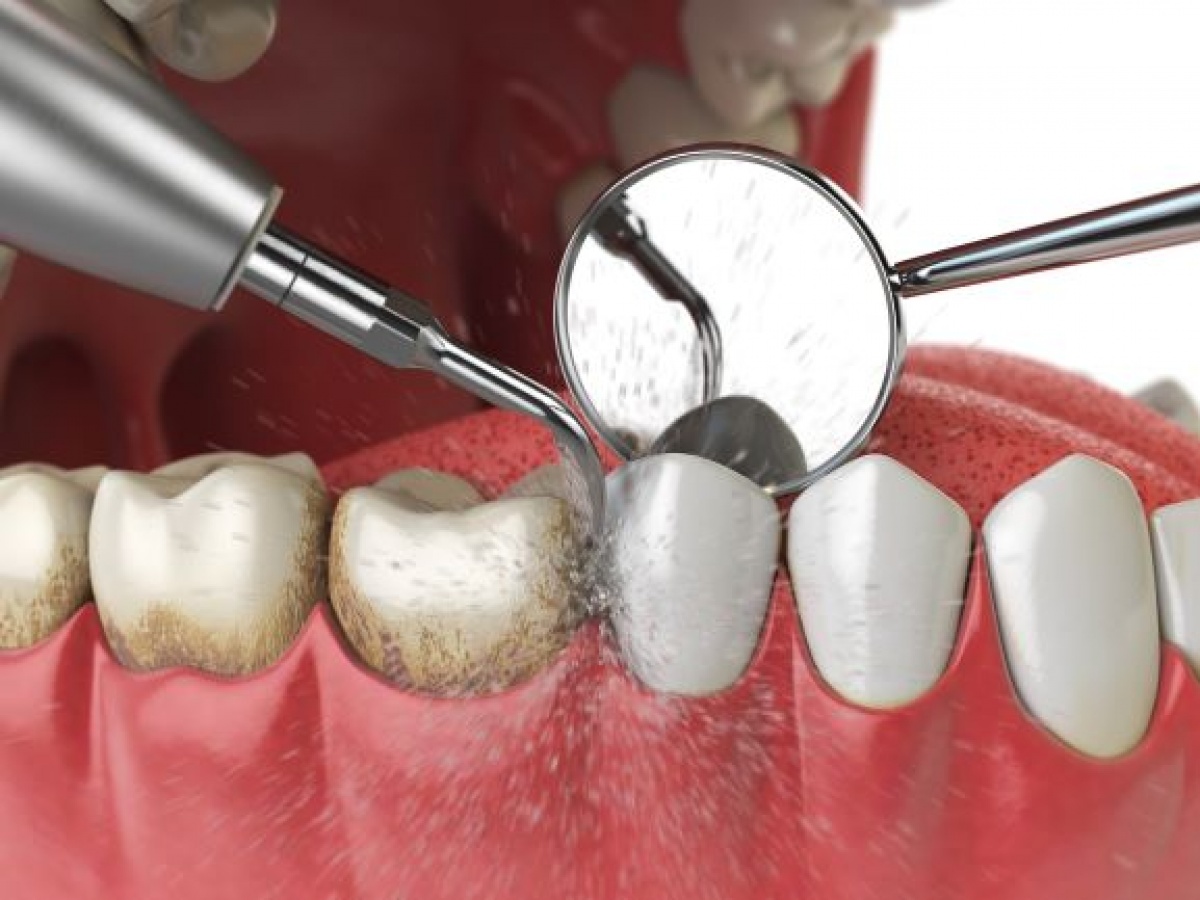 Fogkőeltávolítás, dentálhigiénés kezelés - Budai Dentál Higiénia